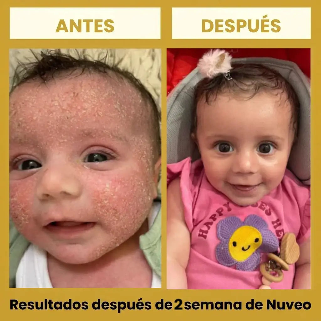 Nuveo™ Crema de Miel para Eccema